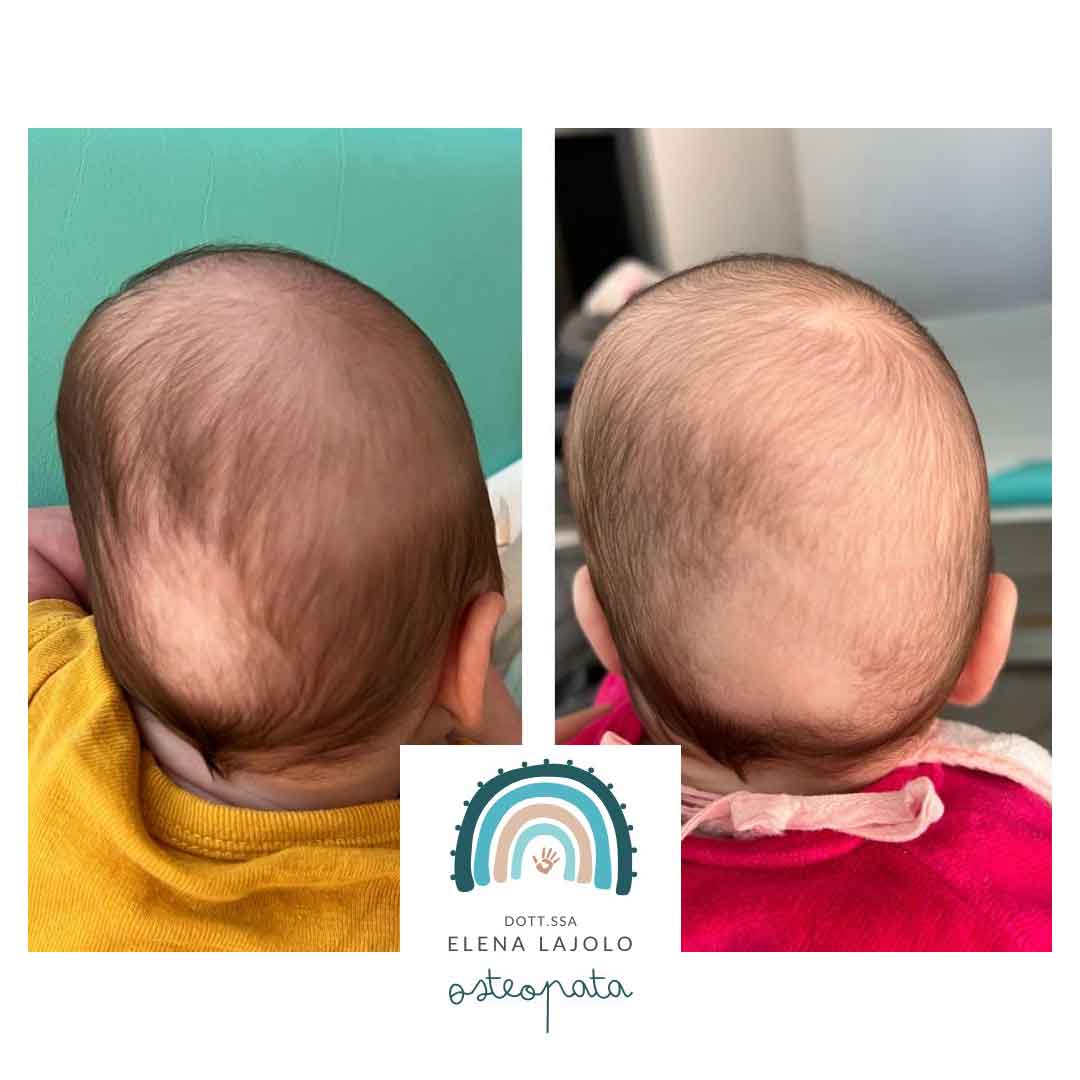 Plagiocefalia-trattata-osteopatia Plagiocefalia trattata
